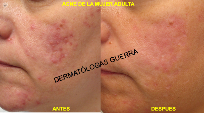 acne adult woman
