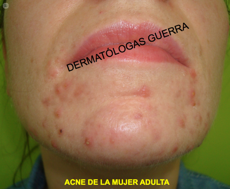 acne photo woman
