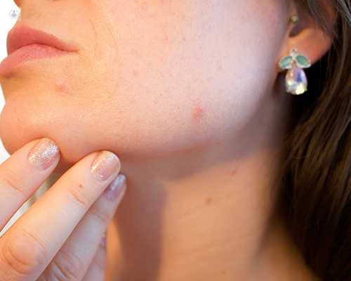 Chica de perfil agarrándose la barbilla y mostrando algunas marcas de acné - cicatrices acné by Top Doctors