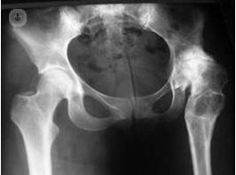 protesica dell'anca giovane paziente