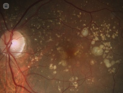 La degeneración macular es una enfermedad que produce lesiones en la retina. El Dr. Gallego te informa 
