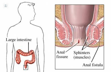 anal fistula image