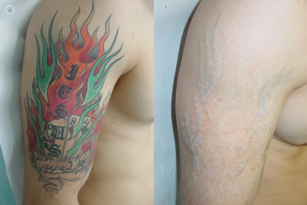 Tatuaje eliminado con láser