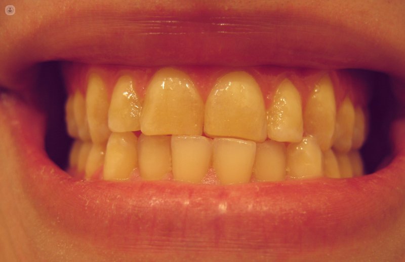 бруксизм зубов
