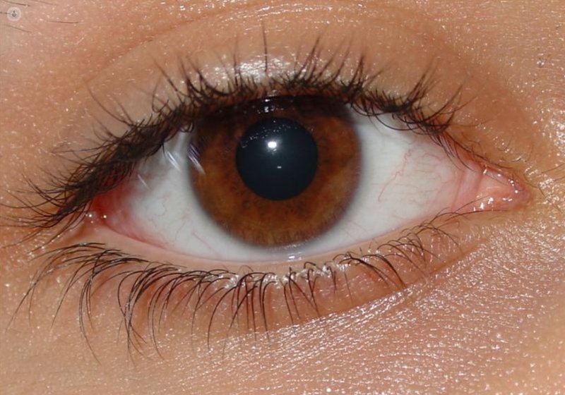 La ptosis palpebral puede ser una causa del ojo vago