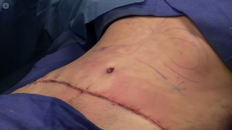 La cirugía de la pared abdominal permite reparar cualquier hernia o flacidez abdominal. 