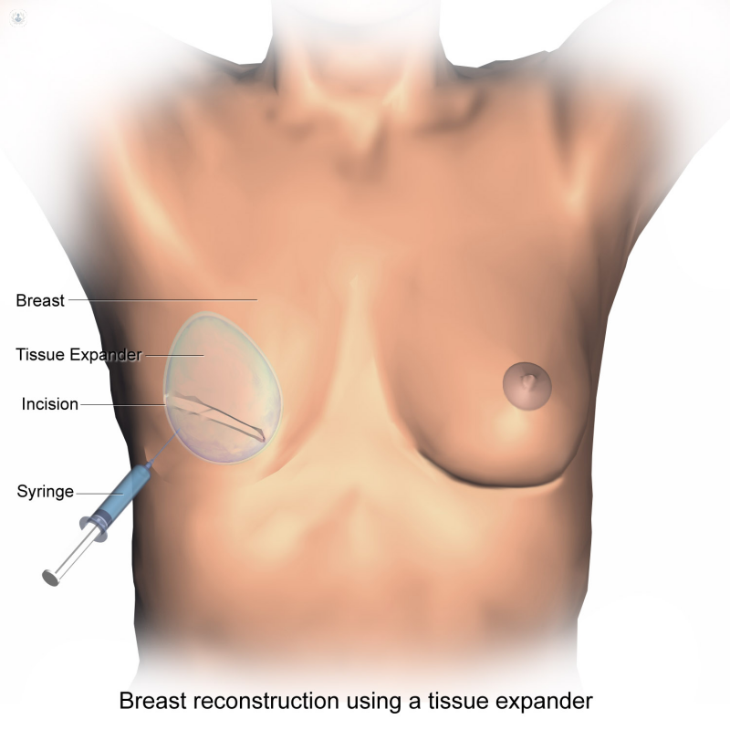 breast reconstruction procedure after breast cancer