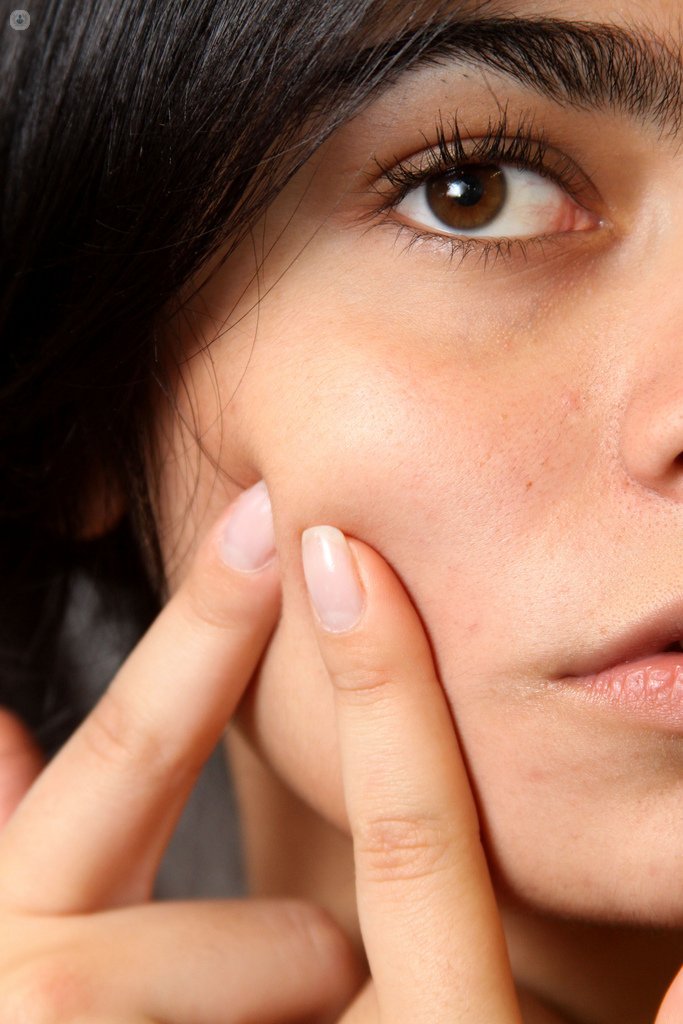 Conoce cómo resolver el acné y sus falsos mitos gracias a este artículo.