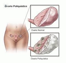 Dibujo ovario poliquistico