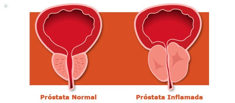 Cirugía láser para la hiperplasia benigna de próstata