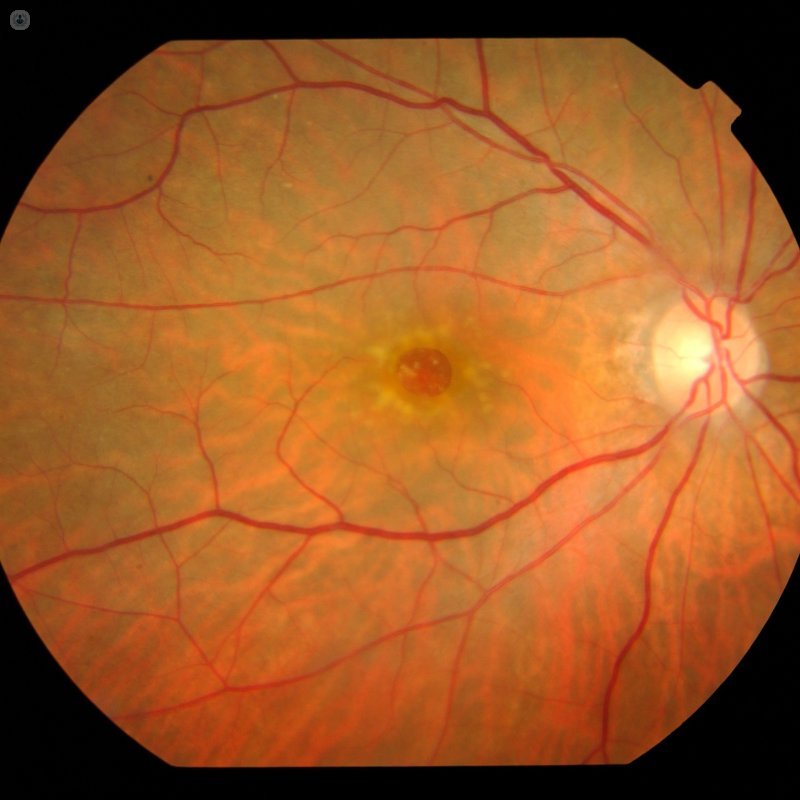 Agujero macular defecto retiniano