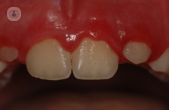 incisivi placca dentale