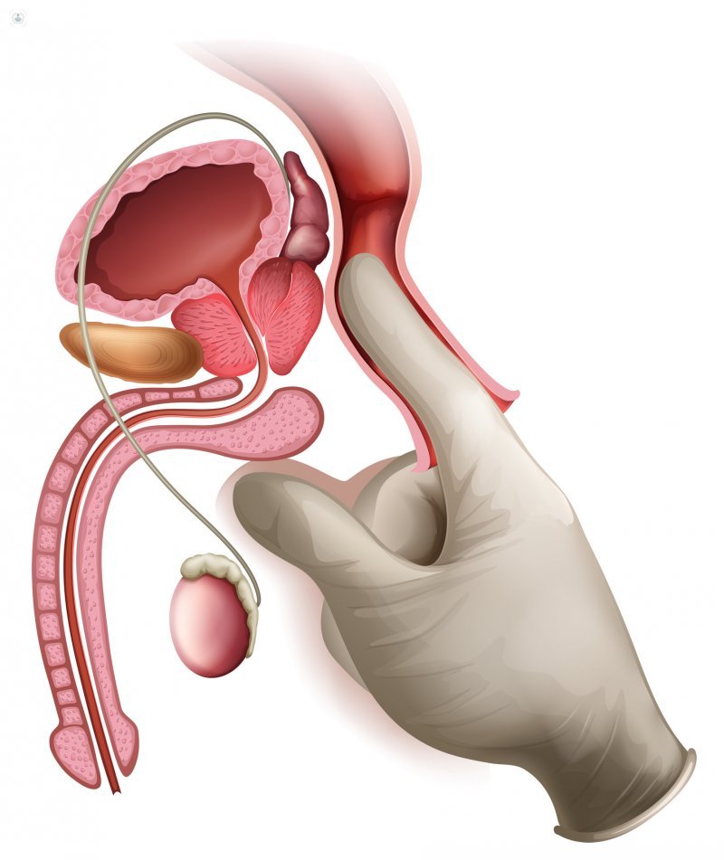 La hiperplasia o hipertrofia benigna de próstata ocurre por estímulo de la testosterona en la glándula prostática
