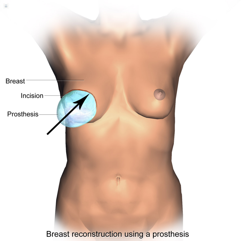 disegno Ricostruzione del seno