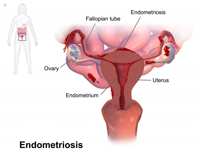 immagine endometriosi