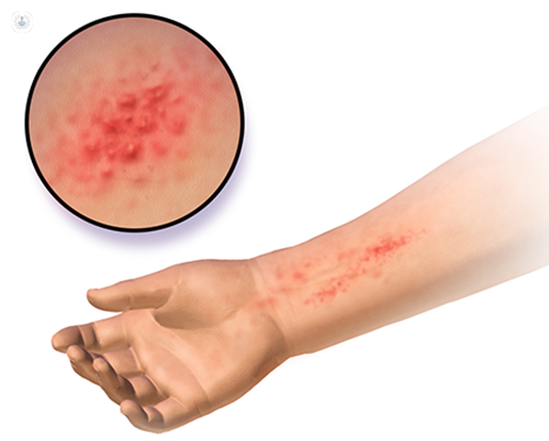 La dermatitis atópica es un trastorno que se traduce en erupciones rojas y picor en la piel
