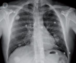 nodulo pulmonar