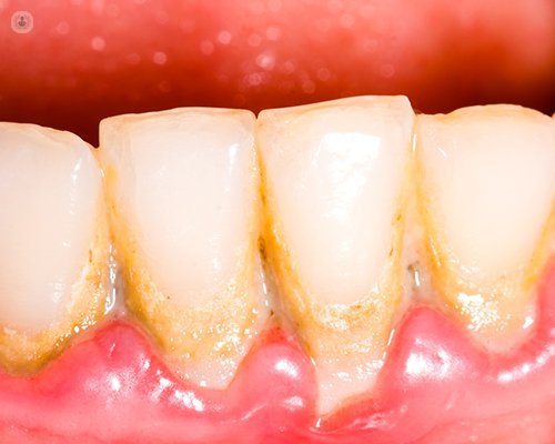 riesgo de periodontitis