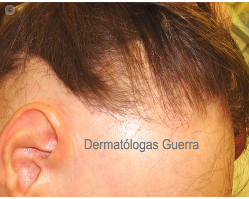 frontale alopecia fibrosante
