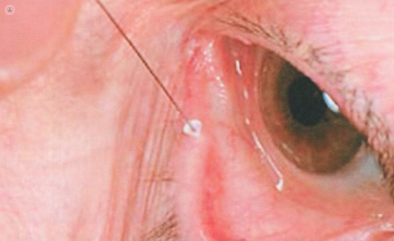 punctal plugs dry eye