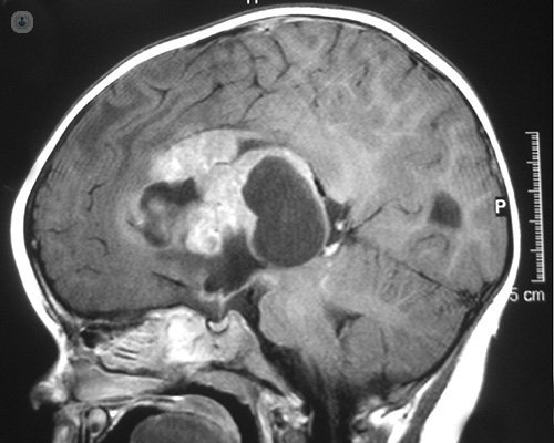 Imagen tumor en el cerebro