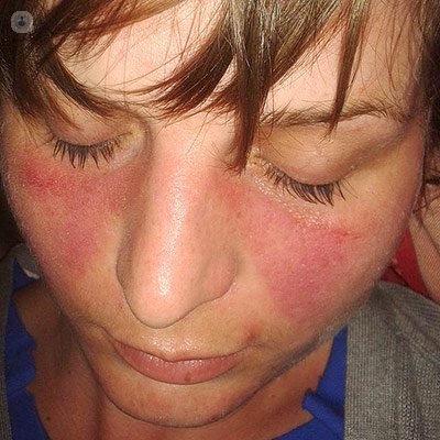 Mujer con lupus en la cara