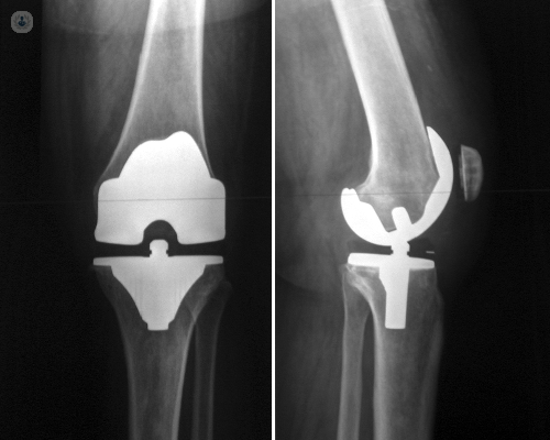La prótesis de rodilla es una articulación artificial