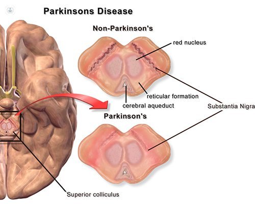 Паркинсон изображение