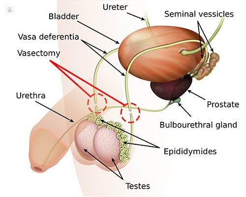vasectomy technique