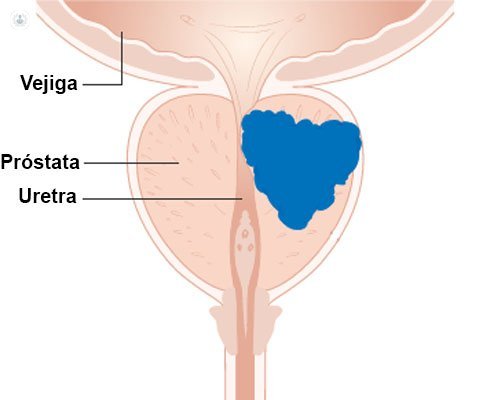 imagen cancer de prostata