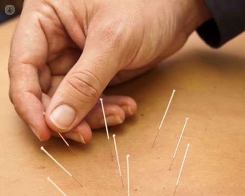 acupuntura para tratar el dolor