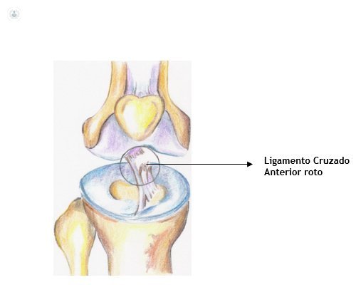 treatment of torn ligament