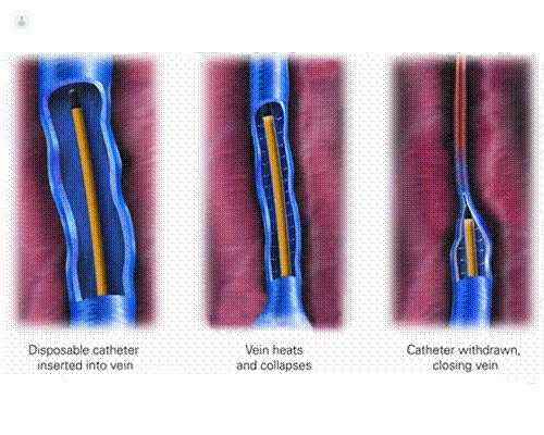 removal of varicose veins