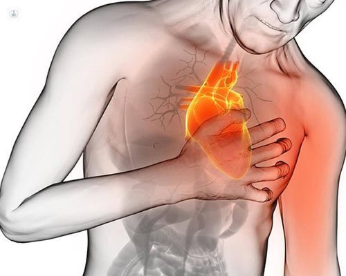 cómo actuar ante un infarto | Top Doctors
