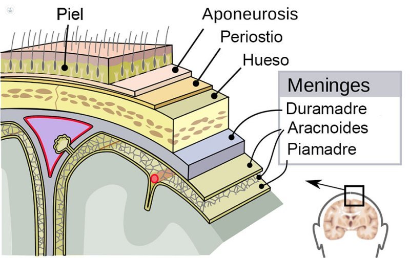 Meningitis inflamación de las meninges