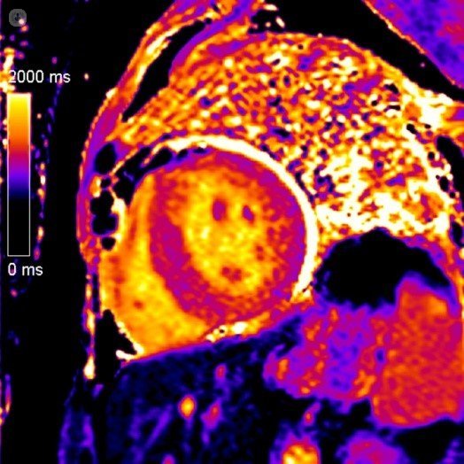 Tecnología mapping T1 escáner de corazón | Top Doctors