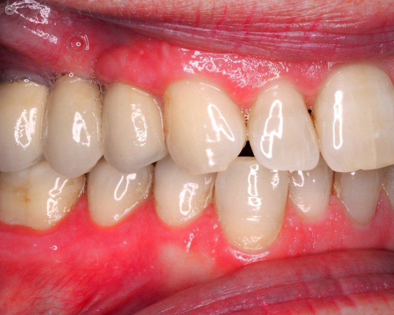 зубной имплантат
