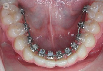 La ortodoncia lingual es una de las más demandadas en adultos