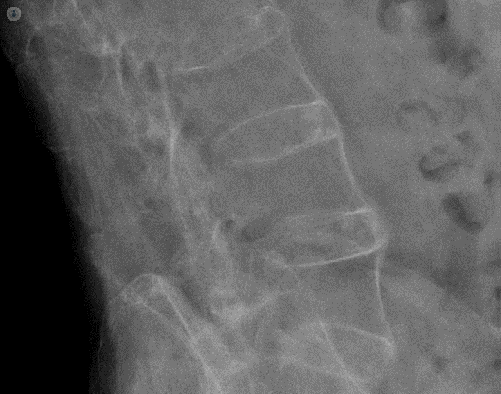 Поясничный отдел позвоночника рентгенография, где сварка между позвонками видела у пациента с расширенным Бехтеревым.