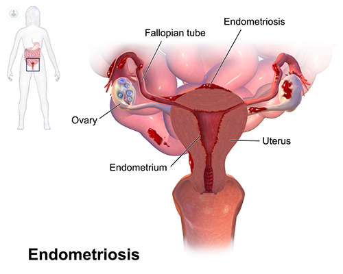 enfermedad endometriosis