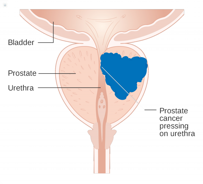 prostatectomía