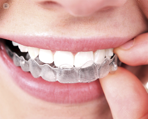 Los dos tipos principales de ortodoncia invisible son Invisalign y ortodoncia lingual