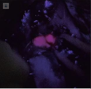 Resección de tumores con fluorescencia: detectar el tejido afectado por un tumor cerebral 