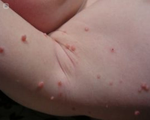 Los moluscos contagiosos suelen aparecer en los pliegues de la piel - Top Doctors