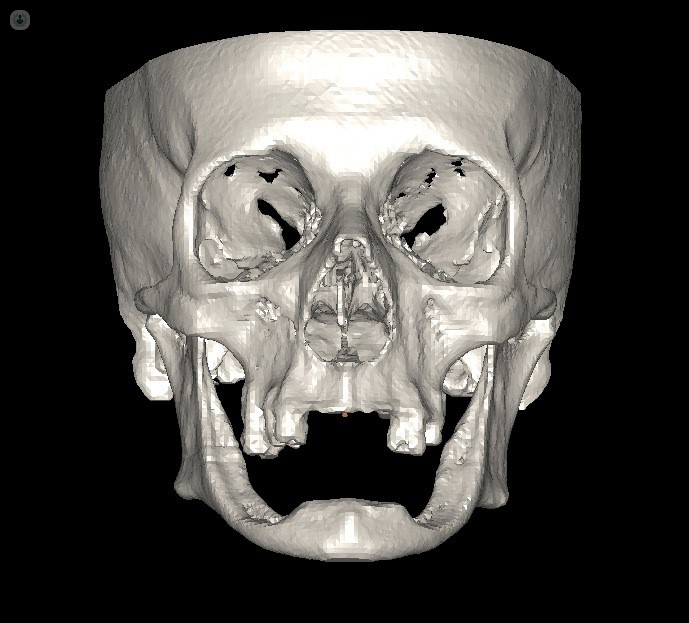 Implantología dental Clínica Cotten