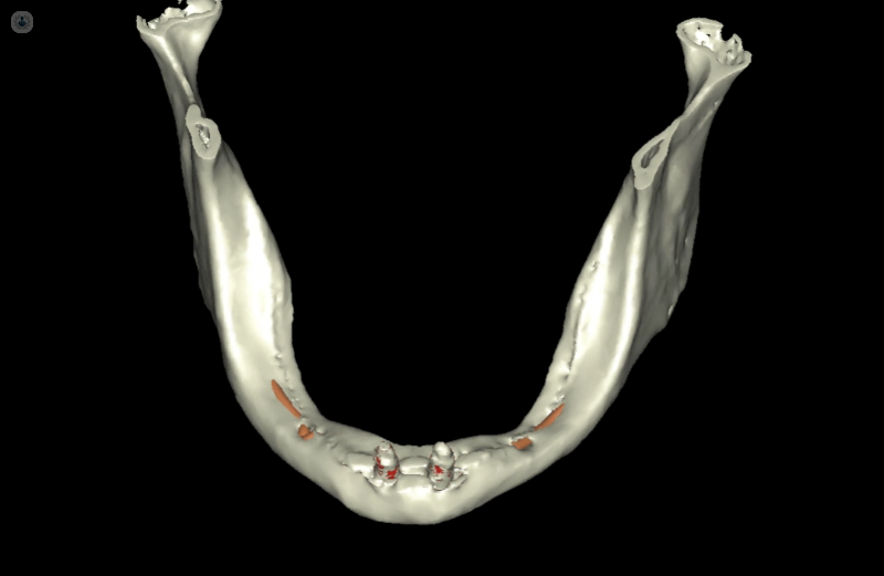 Implantología dental avanzada Dr. Cotten