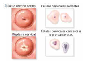 células cancerosas útero | Top Doctors