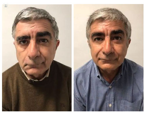 Antes y después del tratamiento de parálisis facial - Top Doctors