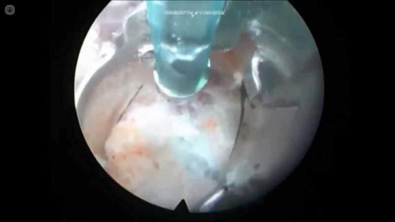 Visión de la cirugía discectomía by Topdoctors