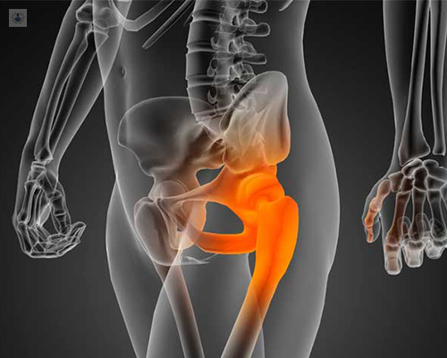 Ilustración de una cadera - operación y prótesis de cadera - by Top Doctors